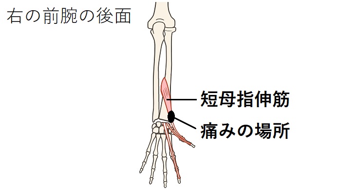 短母指伸筋のイラスト