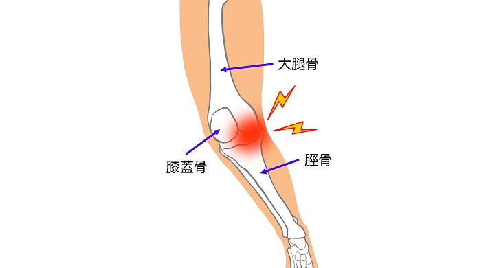 変形性膝関節症のイラスト