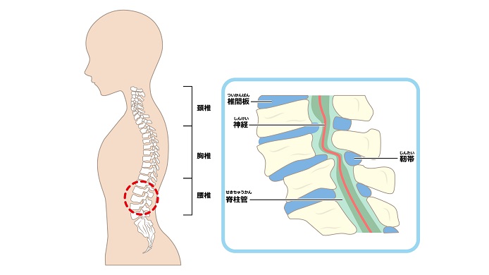 脊柱管狭窄症のイラスト