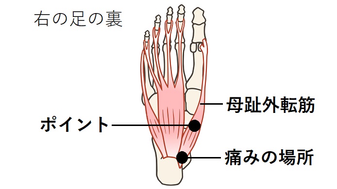 母趾外転のイラスト