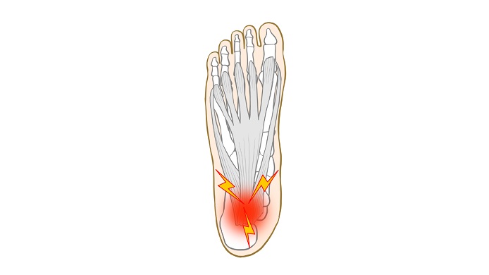 足底腱膜炎のイラスト