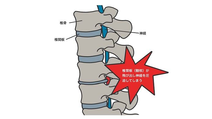 頚椎椎間板ヘルニアのイラスト
