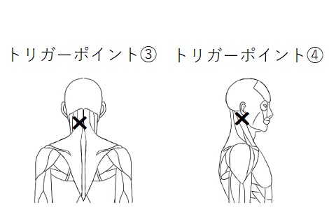 めまいトリガーポイント