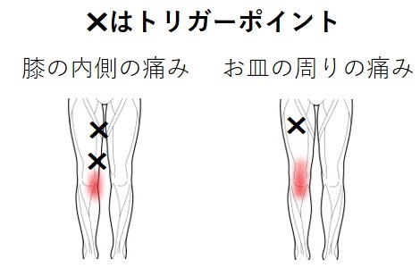 膝の内側とお皿周りの痛みのトリガーポイント