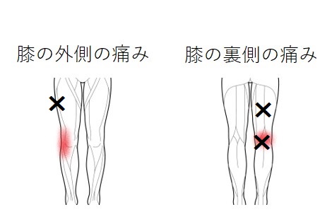 膝の外側と膝の裏側の痛みのトリガーポイント