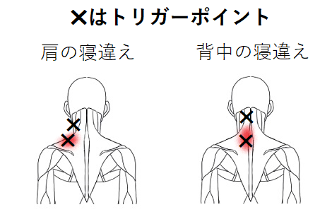 寝違えトリガーポイント