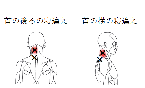 寝違えトリガーポイント