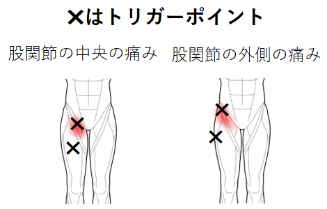 股関節の痛みのトリガーポイント