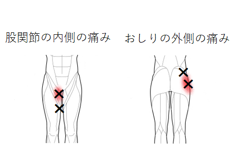 股関節の痛みのトリガーポイント