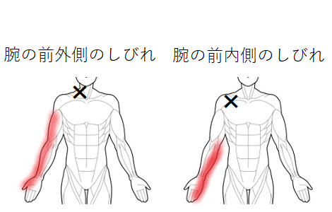 腕のしびれのトリガーポイント