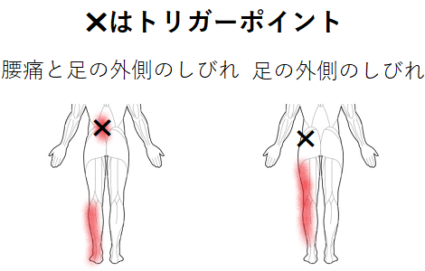 腰痛と足のしびれのトリガーポイント