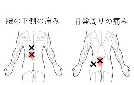 腰痛のトリガーポイント