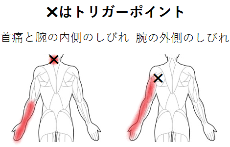 首の痛みと腕のしびれのトリガーポイント