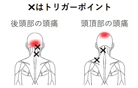 頭痛のトリガーポイント