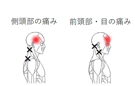 頭痛のトリガーポイント