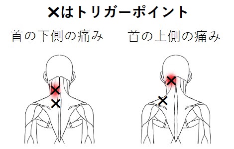 首の痛みのトリガーポイント