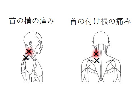 首の痛みのトリガーポイント