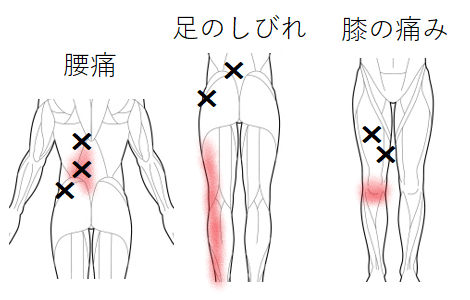 腰痛・足のしびれ・膝の痛みのトリガーポイント